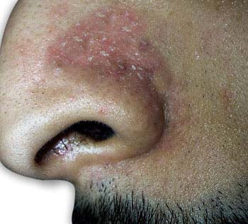 Seborrheic Dermatitis Seborrheic Dermatitis
