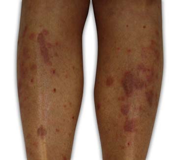 Lichen Planus Lichen Planus