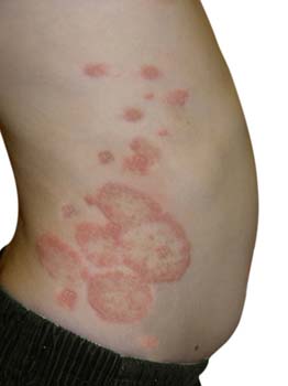Ringworm (tinea corporis) Ringworm (tinea corporis)