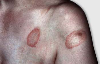 Pityriasis Rosea Pityriasis Rosea