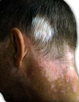 Psoriasis - scalp Symptoms of Psoriasis