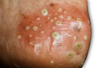 Pustular psoriasis Symptoms of Psoriasis
