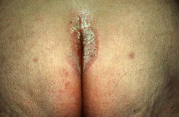 Inverse Psoriasis Symptoms of Psoriasis