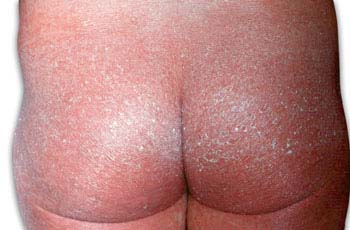 Erythrodermic Psoriasis Symptoms of Psoriasis