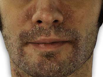 Psoriasis - face Symptoms of Psoriasis