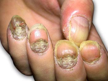 Psoriasis - nails Symptoms of Psoriasis