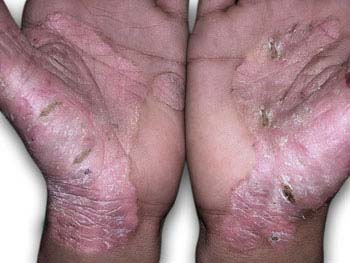 Psoriasis - hands Symptoms of Psoriasis