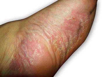 Psoriasis - feet Symptoms of Psoriasis