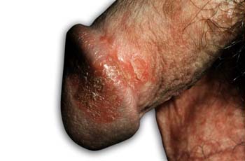 Psoriasis - genitals Symptoms of Psoriasis