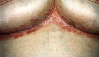 Inverse psoriasis Symptoms of Psoriasis