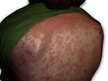 Guttate psoriasis Symptoms of Psoriasis