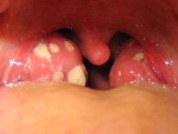 Tonsillitis